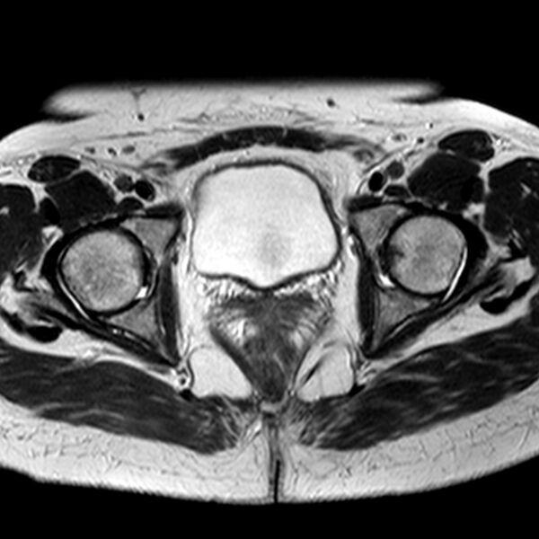 File:Adenomyoma of the uterus (Radiopaedia 9871-10439 Axial T2 10).jpg
