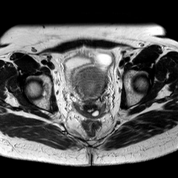 File:Adenomyoma of the uterus (Radiopaedia 9871-10439 Axial T2 13).jpg