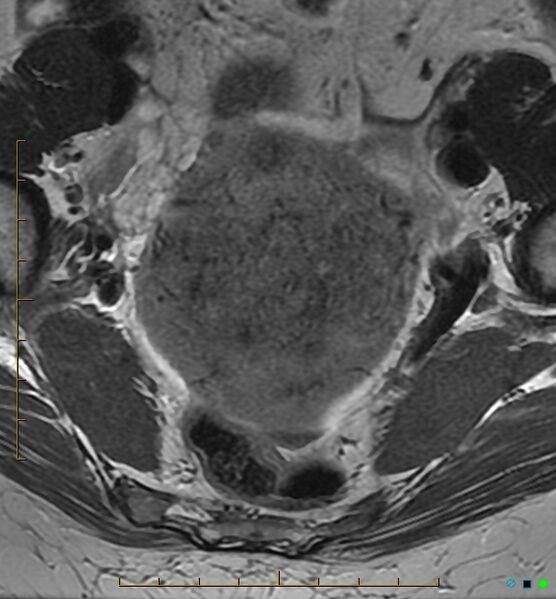 File:Adenomyosis uterus with hematometra (Radiopaedia 45779-50011 Axial T2 8).jpg