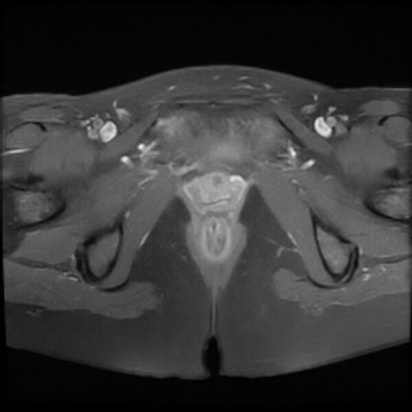 File:Adenomyosis within a septate uterus (Radiopaedia 69963-79981 Axial T1 C+ fat sat 25).jpg