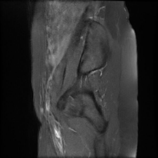 File:Adenomyosis within a septate uterus (Radiopaedia 69963-79981 Sagittal T1 fat sat 3).jpg