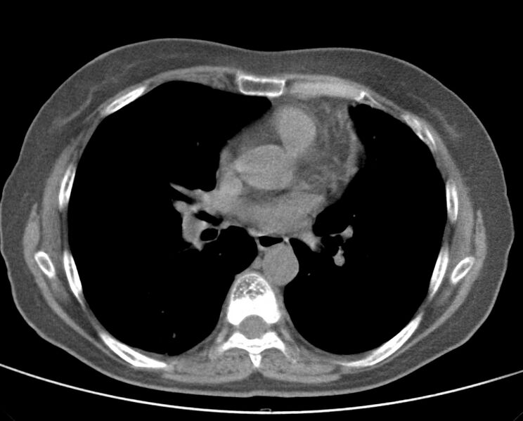 File:Adenosquamous lung carcinoma (Radiopaedia 22035-22030 non-contrast 34).jpg