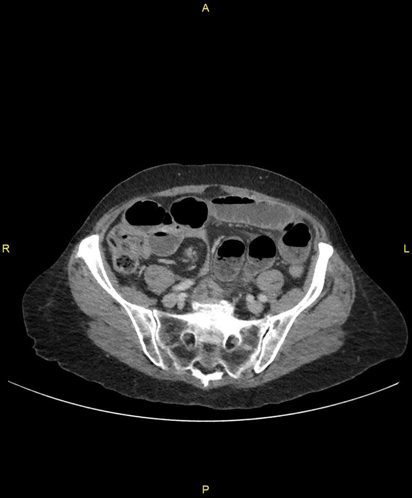 Adhesional small bowel obstruction (Radiopaedia 85402-101024 Axial C+ portal venous phase 208).jpg