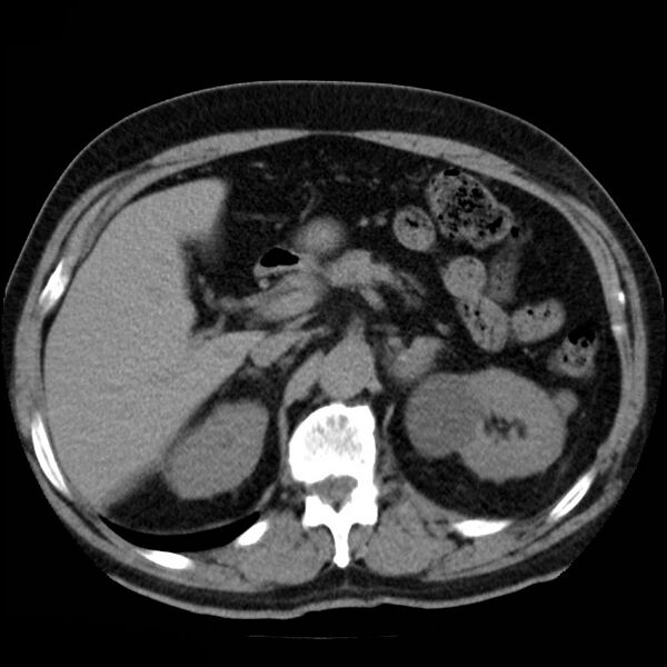 File:Adrenal hemangioma (Radiopaedia 11039-11445 Axial non-contrast 8).jpg