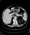 Adrenal myelolipoma (Radiopaedia 6765-7960 Axial C+ arterial phase 8).jpg
