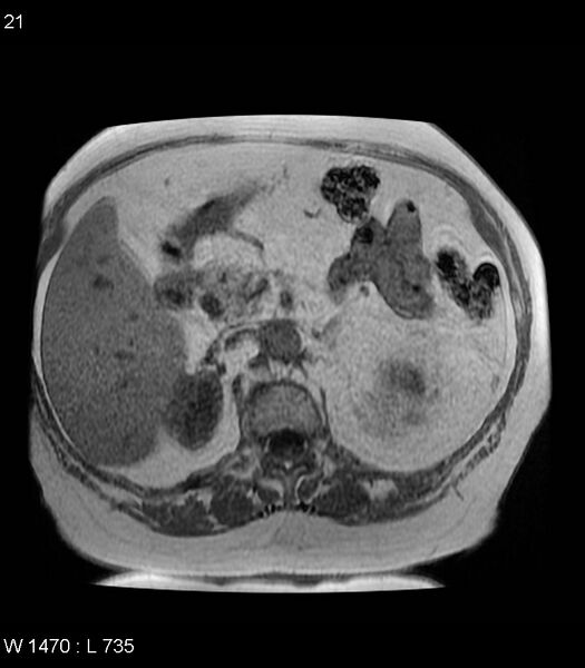File:Adrenal myelolipoma (Radiopaedia 6765-7961 Axial T1 in-phase 21).jpg