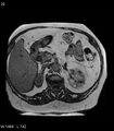 Adrenal myelolipoma (Radiopaedia 6765-7961 Axial T1 out-of-phase 20).jpg