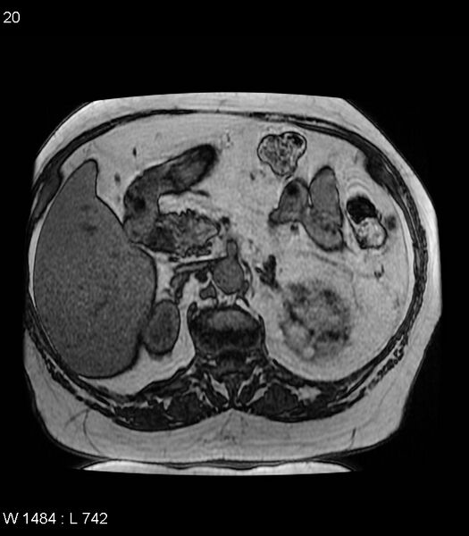 File:Adrenal myelolipoma (Radiopaedia 6765-7961 Axial T1 out-of-phase 20).jpg