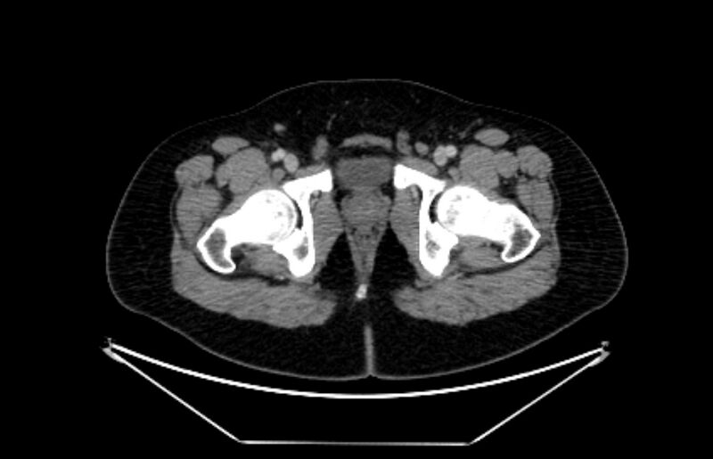 File:Adrenocortical carcinoma (Radiopaedia 80134-93438 Axial C+ portal venous phase 131).jpg
