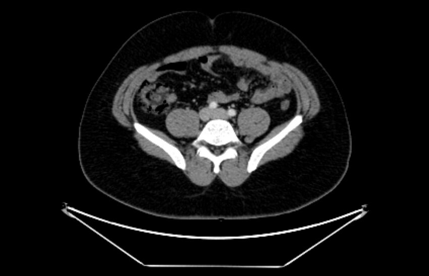 Adrenocortical carcinoma (Radiopaedia 80134-93438 Axial C+ portal venous phase 89).jpg