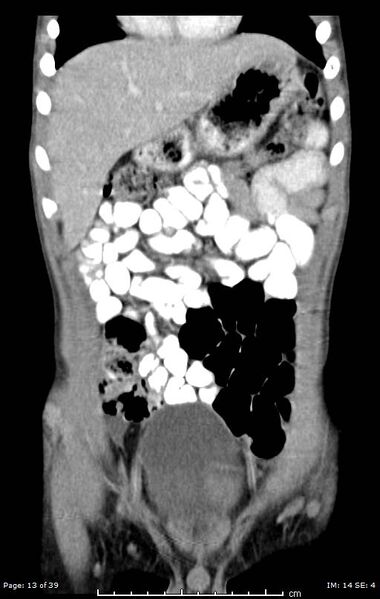 File:Agenesis of the gallbladder (Radiopaedia 55454-61905 A 13).jpg