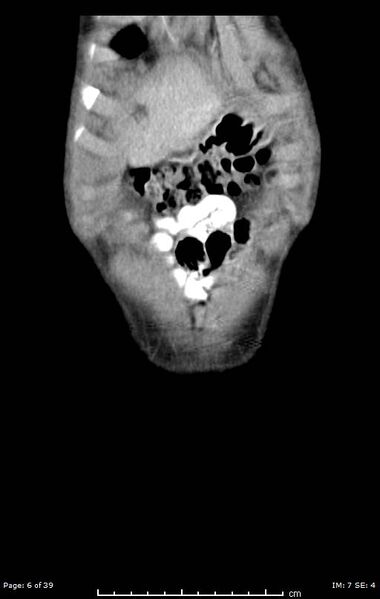 File:Agenesis of the gallbladder (Radiopaedia 55454-61905 A 6).jpg