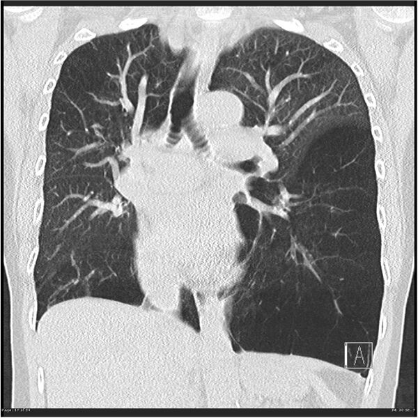 File:Alpha-1-antitrypsin deficiency (Radiopaedia 26537-26678 Coronal lung window 17).jpg