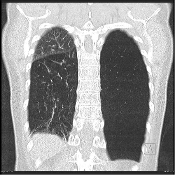 File:Alpha-1-antitrypsin deficiency (Radiopaedia 26537-26678 Coronal lung window 29).jpg