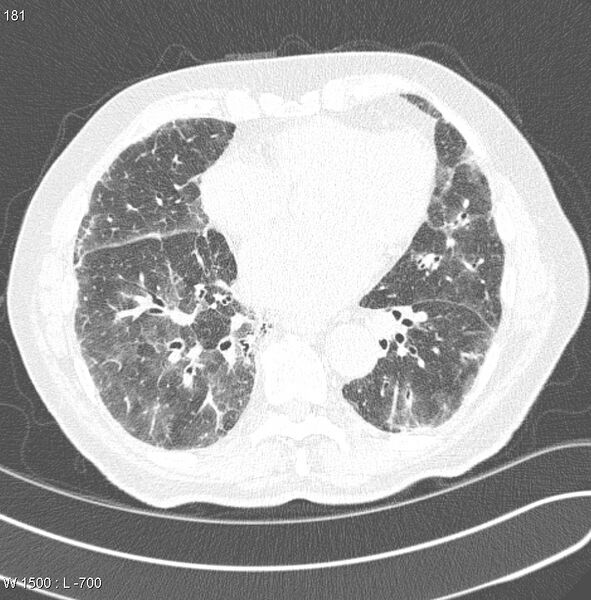 File:Amiodarone lung (Radiopaedia 6539-7851 Axial lung window 18).jpg