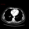 Ampullary carcinoma (Radiopaedia 56396-63056 B 4).jpg