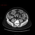 Ampullary carcinoma (Radiopaedia 56396-63056 C 69).jpg
