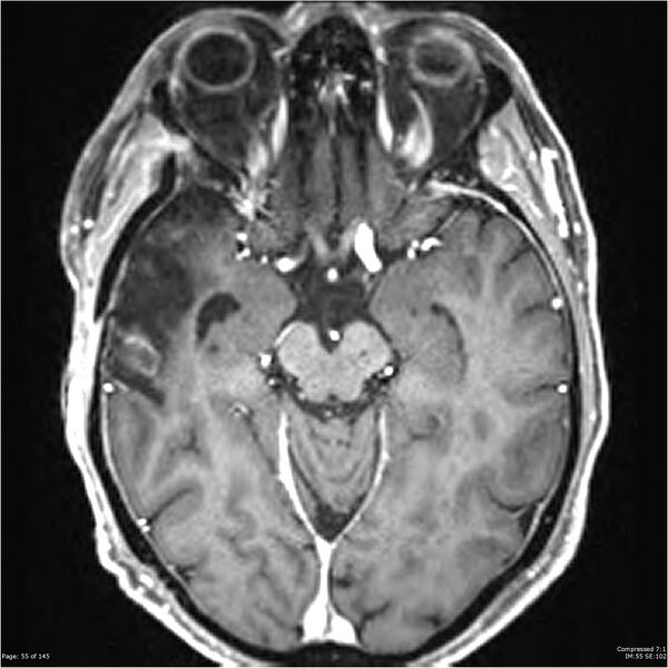 File:Anaplastic meningioma with recurrence (Radiopaedia 34452-35788 Axial T1 C+ 55).jpg