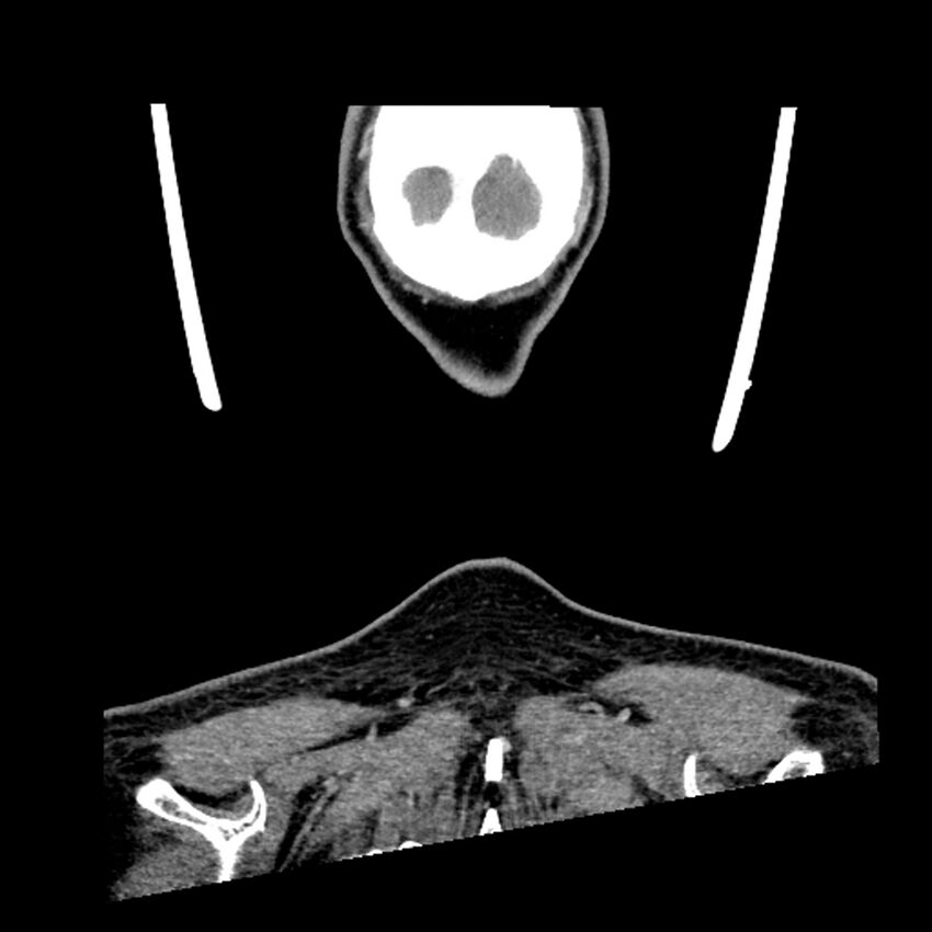 Anaplastic thyroid carcinoma (Radiopaedia 79087-92034 A 113).jpg