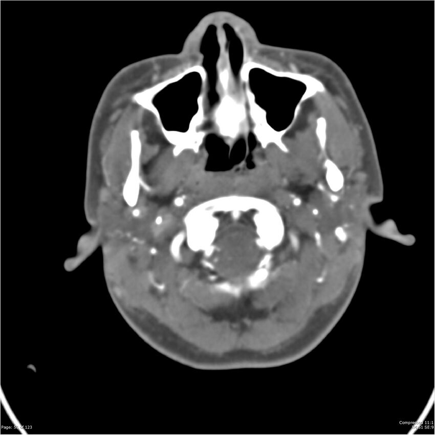 Aneurysmal subarachnoid hemorrhage and Moya Moya disease (Radiopaedia 34306-35593 Axial CT COW 51).jpg