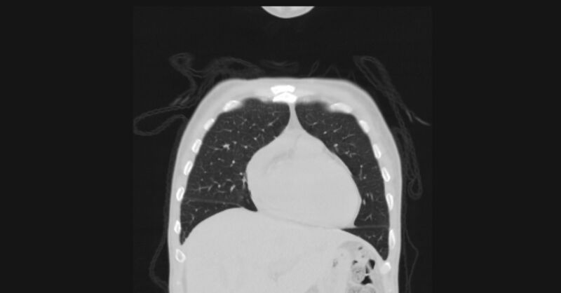 File:Angioinvasive aspergellosis (Radiopaedia 66995-76315 Coronal lung window 13).jpg