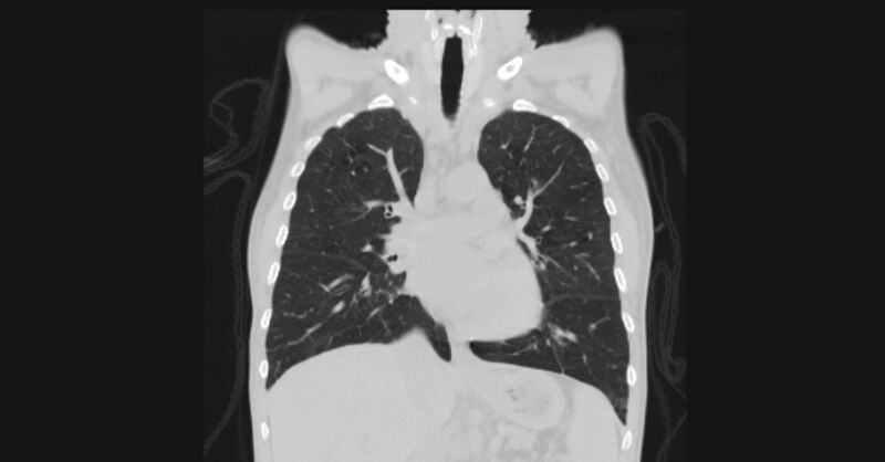 File:Angioinvasive aspergellosis (Radiopaedia 66995-76315 Coronal lung window 29).jpg