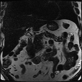 Annular pancreas (Radiopaedia 38292-40320 Coronal T2 17).png