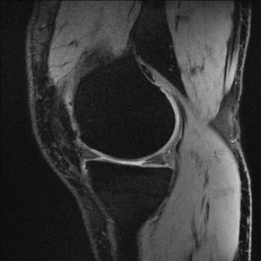 Anterior cruciate ligament mucoid degeneration (Radiopaedia 68400-77933 Sagittal 49).jpg