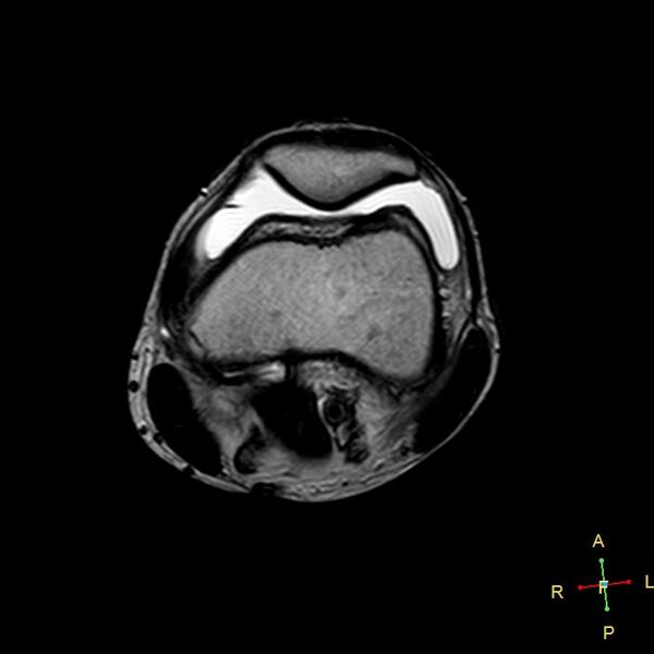 File:Anterior cruciate ligament tear - complete (Radiopaedia 24907-25170 T2 14).jpg