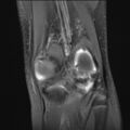 Anterior cruciate ligament tear - pediatric (Radiopaedia 62152-70260 Coronal PD fat sat 5).jpg