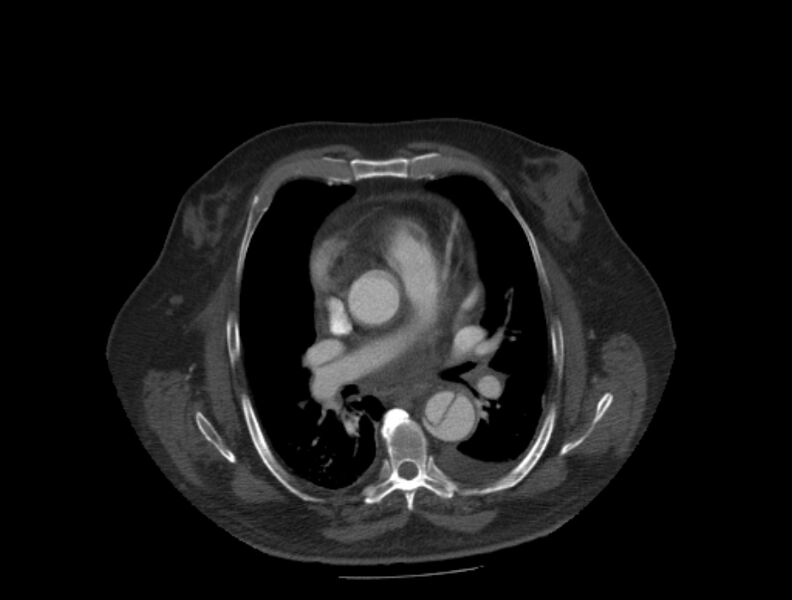 File:Aortic dissection (Radiopaedia 28802-29105 A 18).jpg