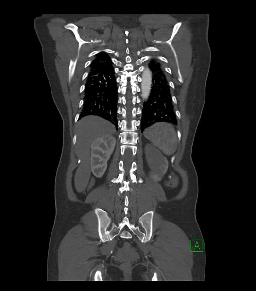 File:Aortic dissection with renal ischemia (Radiopaedia 76573-88338 C 31).jpg