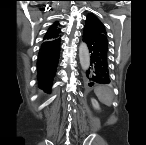 File:Aortic dissection with rupture into pericardium (Radiopaedia 12384-12647 B 37).jpg