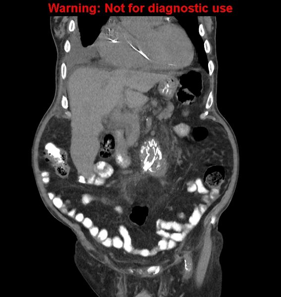 File:Aortic graft infection (Radiopaedia 44979-48907 non-contrast 18).jpg