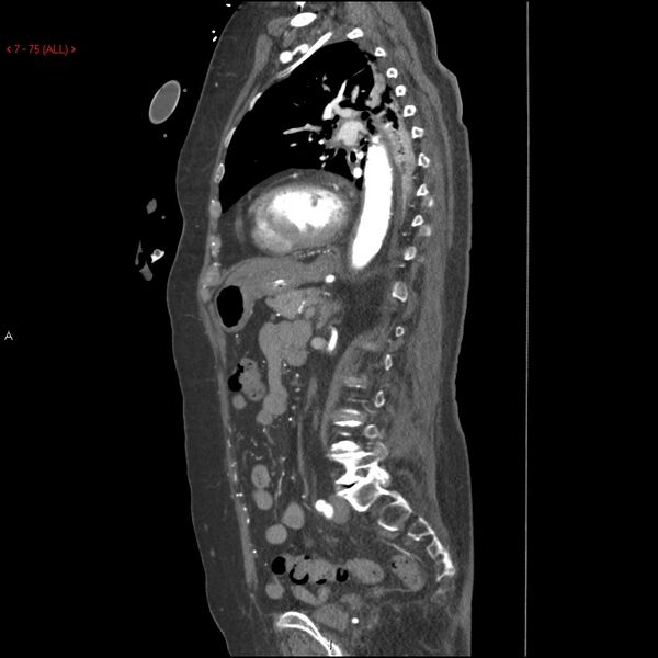 File:Aortic intramural hematoma (Radiopaedia 27746-28001 C 44).jpg