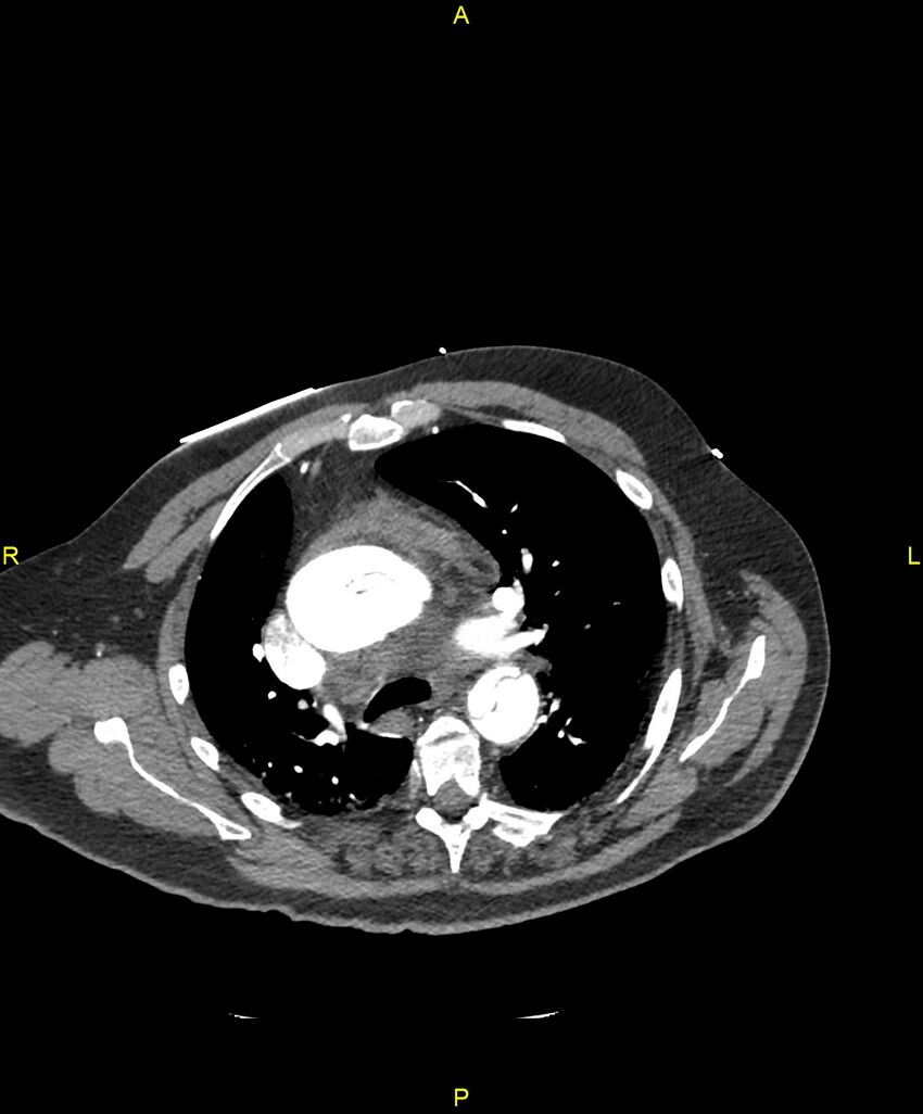 Aortic rupture (Radiopaedia 88822-105594 B 87).jpg