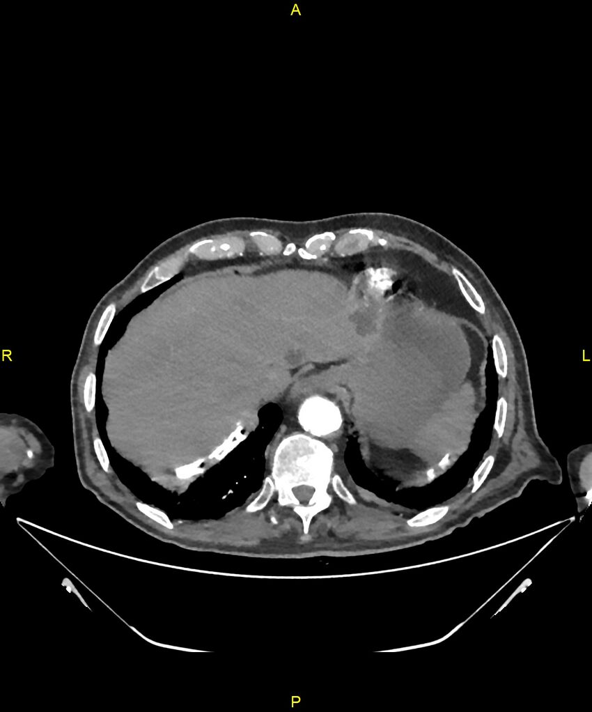 Aortoenteric fistula (Radiopaedia 84308-99603 B 29).jpg