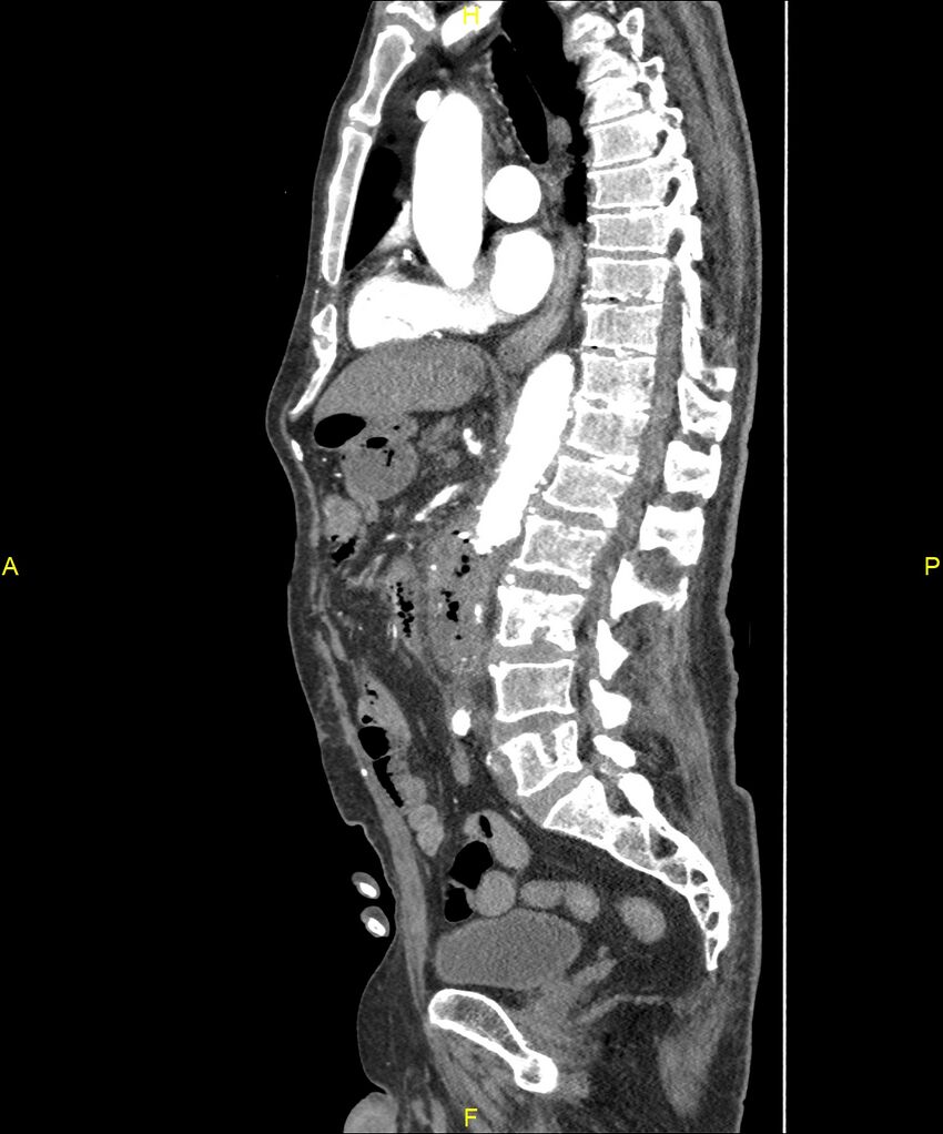 Aortoenteric fistula (Radiopaedia 84308-99603 C 178).jpg