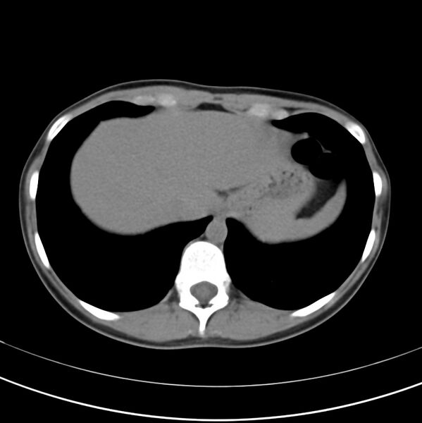File:Appendicitis and incidental bicornuate uterus (Radiopaedia 22833-22853 Axial non-contrast 7).jpg