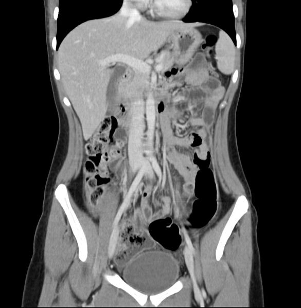 File:Appendicitis and incidental bicornuate uterus (Radiopaedia 22833-22853 D 16).jpg