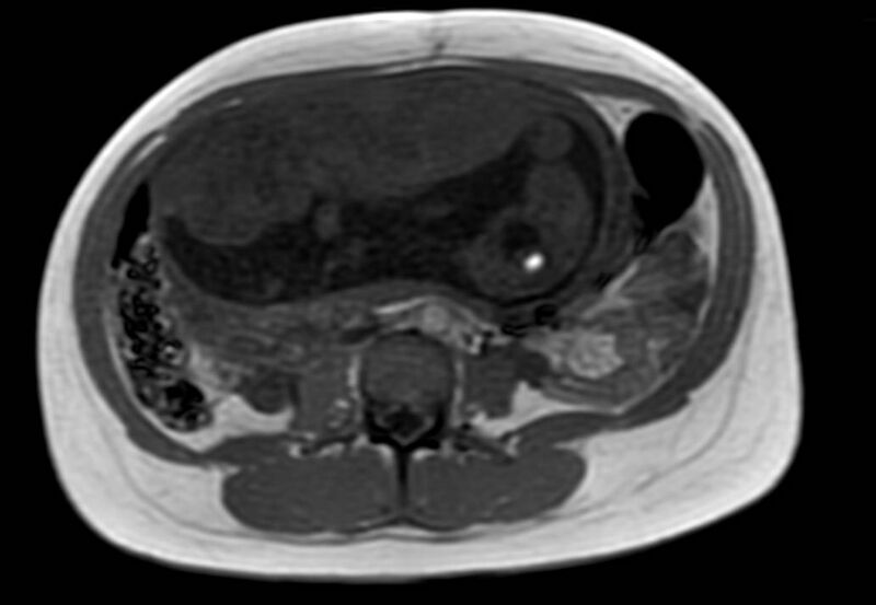 File:Appendicitis in gravida (MRI) (Radiopaedia 89433-106395 Axial T1 in-phase 35).jpg