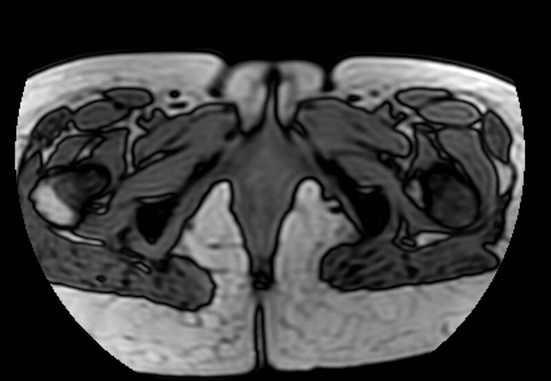 File:Appendicitis in gravida (MRI) (Radiopaedia 89433-106395 D 74).jpg