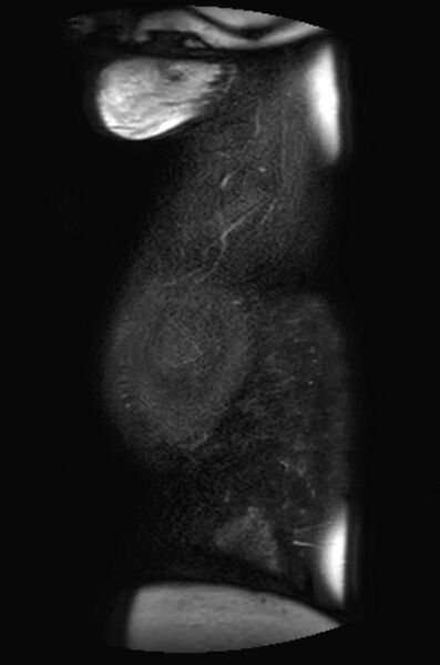 File:Appendicitis in gravida (MRI) (Radiopaedia 89433-106395 Sagittal T2 SPAIR 2).jpg