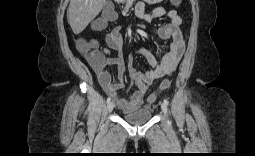 Appendix mucocele (Radiopaedia 41222-44033 B 27).jpg