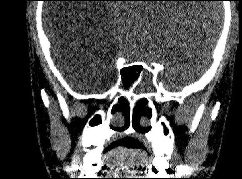 Arachnoid cyst- extremely large (Radiopaedia 68741-78450 Coronal bone window 27).jpg