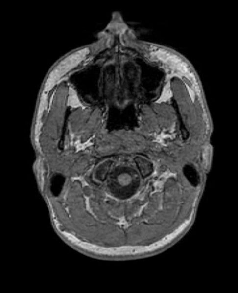 File:Arachnoid cyst- extremely large (Radiopaedia 68741-78451 Axial T1 6).jpg