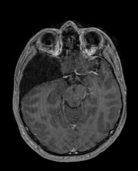 File:Arachnoid cyst- extremely large (Radiopaedia 68741-78451 Axial T1 C+ 34).jpg