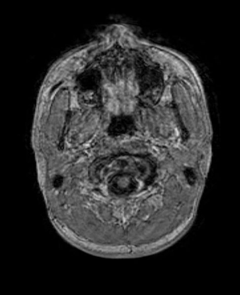 File:Arachnoid cyst- extremely large (Radiopaedia 68741-78451 Axial T1 C+ 6).jpg