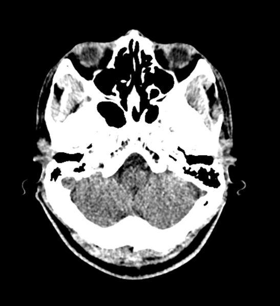 File:Arachnoid cyst of the ambient cistern (Radiopaedia 81301-94986 Axial non-contrast 12).jpg