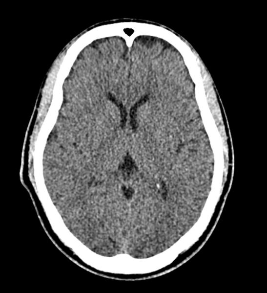File:Arachnoid cyst of the ambient cistern (Radiopaedia 81301-94986 Axial non-contrast 38).jpg